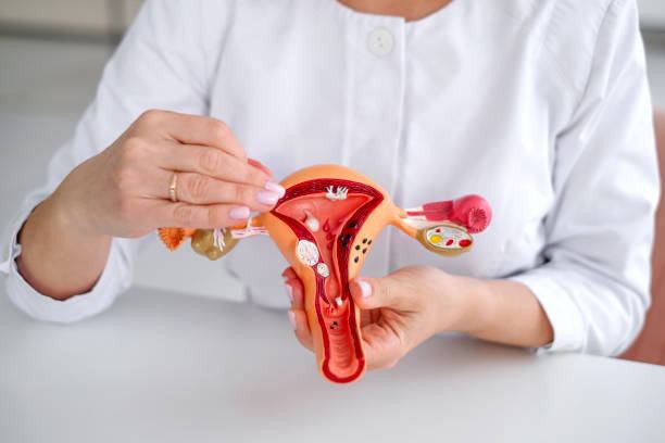 Modelo anatómico de miomas uterinos